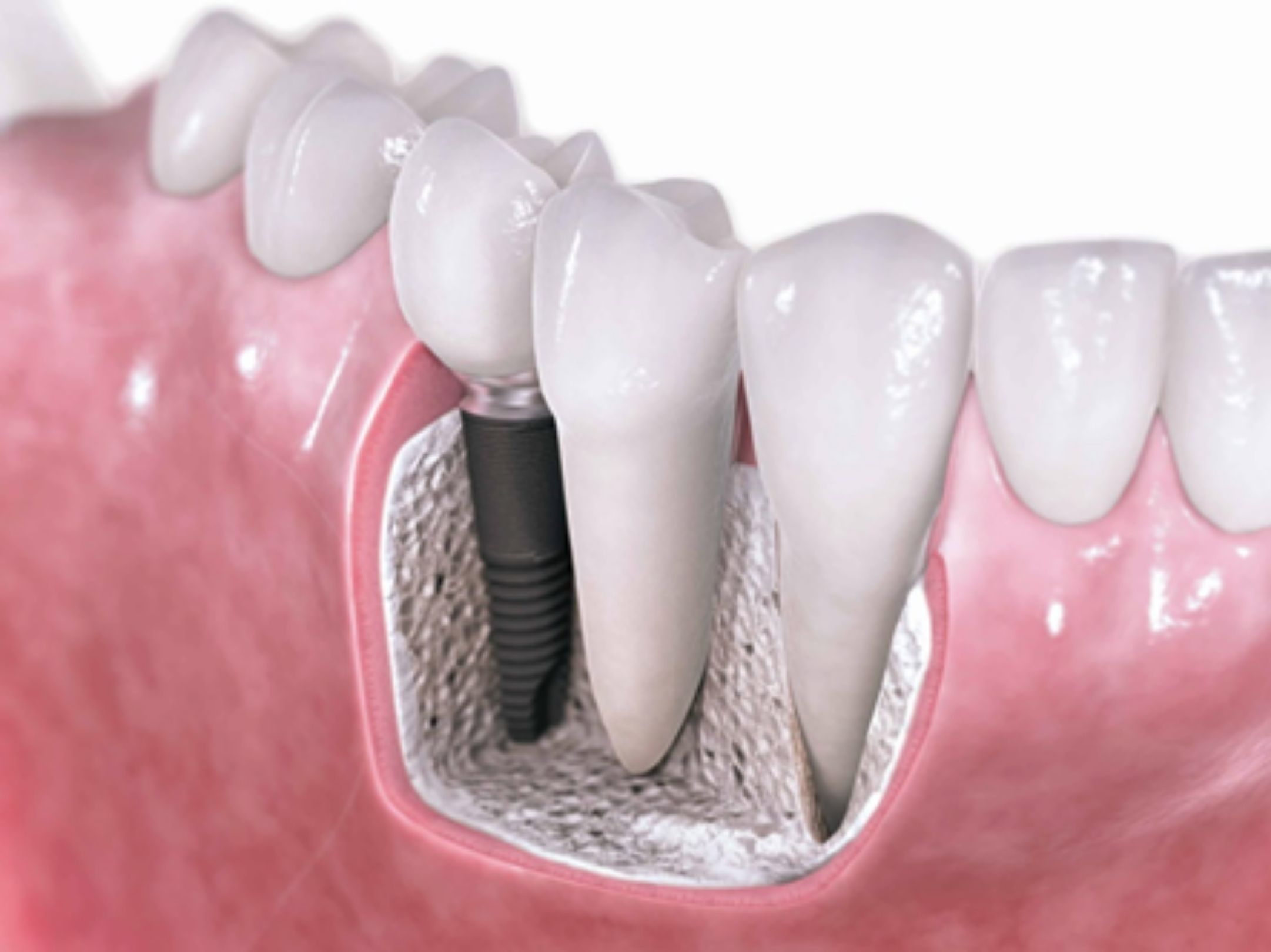 Implante dental osteointegrado