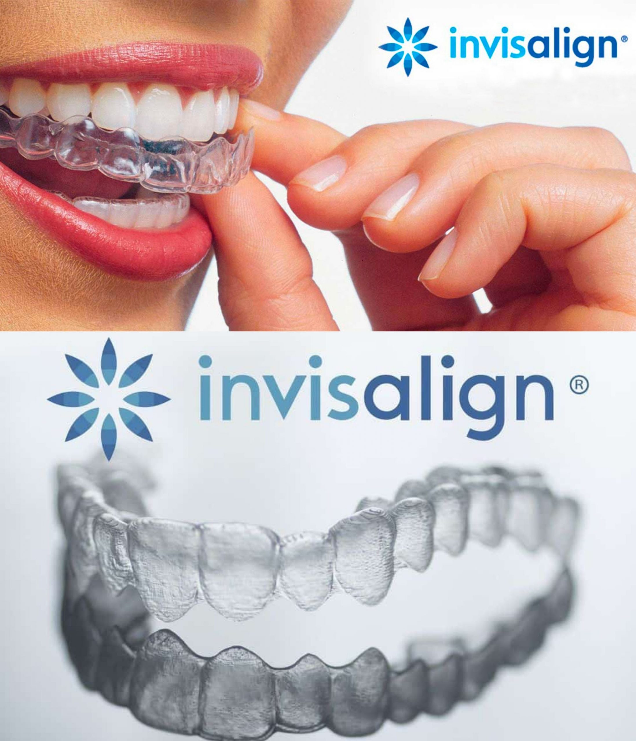 Sistema Invisalign